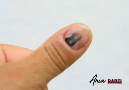 Stłuczony paznokieć: jak leczyć? Kiedy do lekarza, a kiedy domowe sposoby?