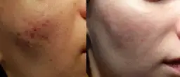 Przed i po: skóra z widocznymi śladami po pryszczach po lewej, gładka i czysta po prawej. Dowiedz się, jak szybko zagoić ranę po pryszczu.