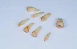 Ból po wyrwaniu ósemki: Jak długo? Kiedy do dentysty?