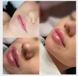 Ile kosztuje powiększanie ust 0 5ml? Sprawdź ceny w różnych miastach