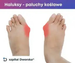 Ile kosztuje operacja haluksów? Cennik NFZ vs. Prywatnie 2025