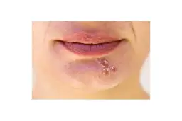 Skuteczne leki na opryszczkę bez recepty – ulga w objawach i leczeniu