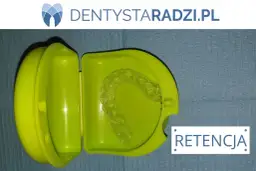 Cena nakładki retencyjnej po aparacie: Ile kosztuje i którą wybrać?