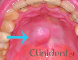 Gula na podniebieniu: Przyczyny i kiedy udać się do lekarza
