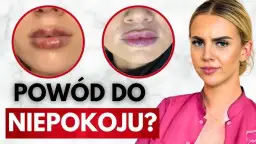 Jak zlikwidować siniaki po kwasie hialuronowym? Szybkie triki!