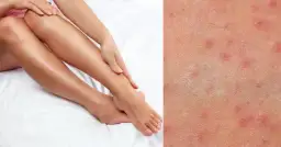 Krostki po goleniu? Pozbądź się ich! Gładka skóra bez podrażnień