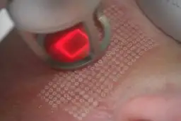 Zabieg laserem frakcyjnym: czy laser frakcyjny jest bezpieczny? Skóra po zabiegu z widocznymi mikrouszkodzeniami.