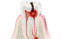 Czy dentysta wyrwie zęba z ropą? Poznaj ryzyko i rozwiązania