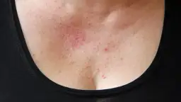 Überdosierung von Vitamin B12: Risiken, Nebenwirkungen und Sicherheit