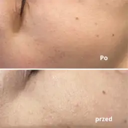 Kiedy makijaż po laserze frakcyjnym? Bezpieczne terminy i zasady