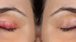 Choroby powiek: objawy i zdjęcia, które pomogą w identyfikacji