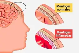Síntomas de meningitis que no debes ignorar para tu salud
