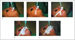 Intubacja ile może trwać? Poznaj czynniki wpływające na czas trwania