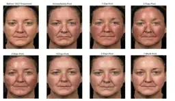 Jak pielęgnować twarz po laserze frakcyjnym, aby uniknąć komplikacji