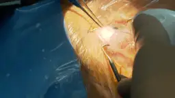 Jak długo trwa rehabilitacja po operacji jaskry? Oczekiwania i porady