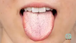 Grzybica jamy ustnej: Objawy, leczenie, zdjęcia Rozpoznaj i pokonaj!