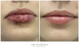 Ulga po powiększaniu ust: Ból, obrzęk? Ekspert radzi, co robić.