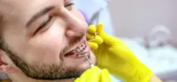 Czy zakładanie aparatu na zęby boli? Prawda o dyskomforcie i odczuciach