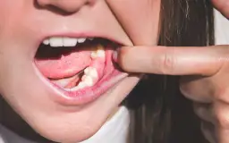 Ból po ósemce: Kiedy minie? Normalne objawy czy suchy zębodół?