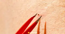 Mały kleszcz? Jak usunąć nimfę: Bezpiecznie, szybko, bez błędów!