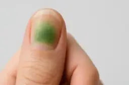 Zielona plama na paznokciu: leczenie, przyczyny i jak odróżnić od grzybicy