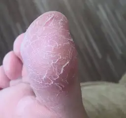 Pierwsze objawy grzybicy na stopach – jak je rozpoznać i leczyć