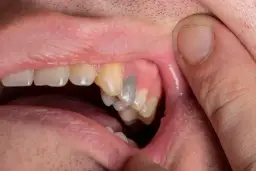 Martwy ząb: Czy wypadnie? Jak go uratować i zachować na lata?