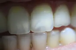 Jak usunąć przebarwienia z zębów? Kompleksowy przewodnik i koszty