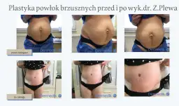 Liposukcja: Co to jest i czy to rozwiązanie dla Ciebie?