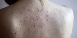 Skóra pleców z licznymi czerwonymi krostkami. Szukasz sposobu, jak pozbyć się pryszczy na plecach?