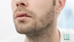 Czy z opryszczką można iść do dentysty? Ważne zasady bezpieczeństwa