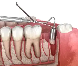 Higiena po ekstrakcji zęba: Bezpieczny przewodnik krok po kroku