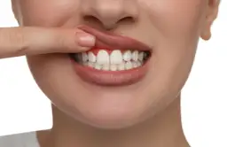 Skuteczne sposoby na podrażnione dziąsła - ulga i szybkie leczenie