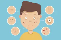 Skuteczne domowe sposoby na pryszcze, które naprawdę działają