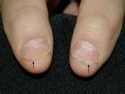 Łuszczyca paznokci czy jest zaraźliwa? Odkryj prawdę o chorobie