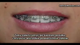 Ile trwa zakładanie aparatu i czy boli? Przewodnik ortodonty