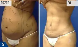 Liposukcja brzucha: Ile naprawdę zapłacisz? Cennik i porady