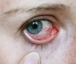 Fibromyalgie Symptome Augen: Unerwartete Beschwerden und Lösungen