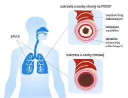 Czy POChP kwalifikuje do renty? Sprawdź, co musisz wiedzieć