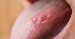 Wczesne objawy raka dna jamy ustnej: Sprawdź, co musisz wiedzieć