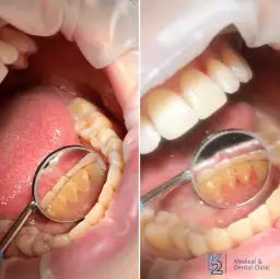 Usuwanie kamienia nazębnego: co działa, a co szkodzi?