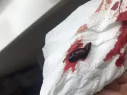 Skrzep jak wątróbka w ciąży – co to oznacza dla zdrowia?