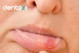 Afty na dziąśle: Szybka ulga i skuteczne leczenie co działa?