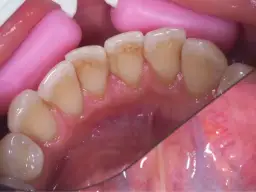 Jak wygląda kamień na zębach? Objawy i skutki zdrowotne