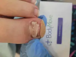 Klamra na paznokciu u stopy, przyklejona plastrem, z widocznym elementem metalowym.