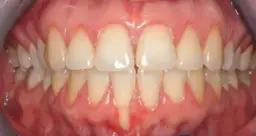 Ile kosztuje przeszczep dziąsła? Ceny w Polsce i różnice w klinikach