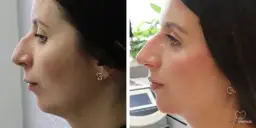 Aparat ortodontyczny a rysy twarzy: Odkryj, jak zmieni się Twój profil