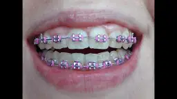 Jak wyglądają aparaty na zęby? Odkryj różnice i estetykę