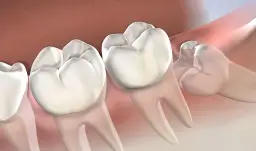 Medicamentos que se recetan después de una extracción dental y sus efectos