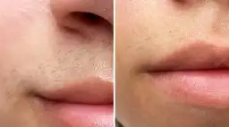 Kiedy wypadają włosy po depilacji laserem? Sprawdź, co musisz wiedzieć